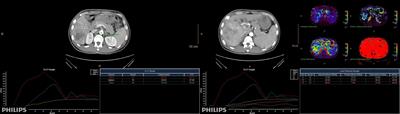 Clinical application of spectral CT perfusion scanning in evaluating the blood supply source of portal vein tumor thrombus in hepatocellular carcinoma